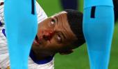 PIX: Mbappe breaks nose after collision at Euros