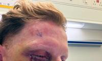Ben Stokes undergoes successful eye surgery