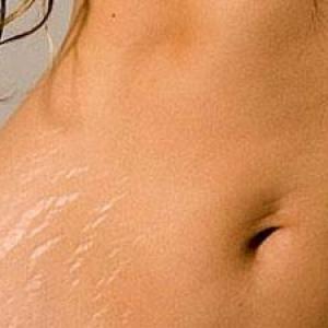 Effective home remedies for stretch marks