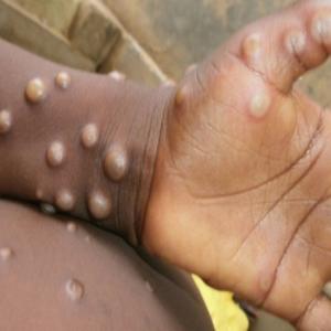 Delhi monkeypox patient attended stag party in Manali