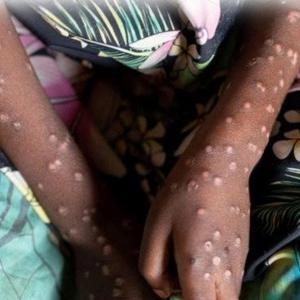 Prevent undue panic: Centre advises states on mpox