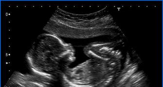SC allows woman to abort 24-week foetus without skull