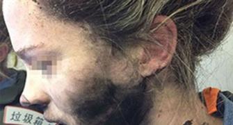 Woman's face burned after headphones explode mid-flight