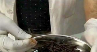 WTF: 116 iron nails removed from man's stomach