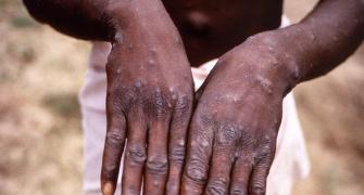 US confirms first case of monkeypox