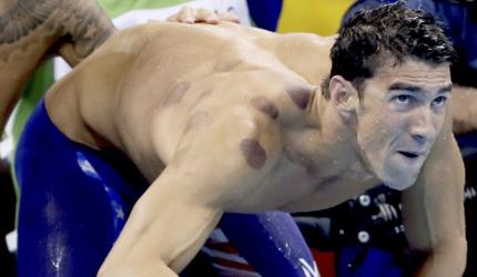 Here's why Phelps has those big red circles all over his back