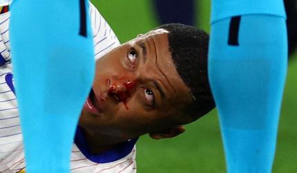 PIX: Mbappe breaks nose after collision at Euros