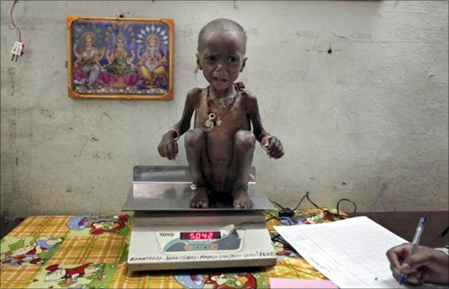 Severely malnourished two-year-old girl Rajni is weighed by health workers at the Nutritional Rehabilitation Centre of Shivpuri district in Madhya Pradesh.