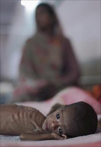 our-month-old Vishakha, who weighs 2.3 kg (5 lbs) and suffers from severe malnutrition, rests on a bed next to her mother at the Nutritional Rehabilitation Centre of Shivpuri district in Madhya Pradesh.