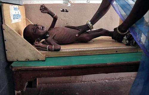 Health workers measure the height of severely malnourished two-year-old girl Rajni at the Nutritional Rehabilitation Centre of Shivpuri district in Madhya Pradesh.
