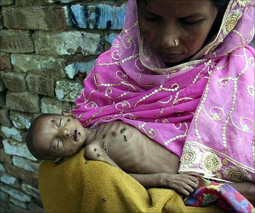 Naushad, 18-months-old and suffering from severe malnutrition, lies on his mother's lap inside their residence in Kalonda village near Sikandrabad district in Uttar Pradesh.