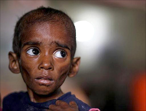 Ranbir, twenty-six-months, who weighs 5 kg and suffers from severe malnutrition, waits for food at the Nutritional Rehabilitation Centre of Shivpuri district in Madhya Pradesh.