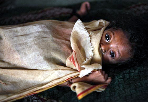 Six-month-old Kiran, who weighs 3.5 kg and suffers from severe malnutrition, lies in bed at the Nutritional Rehabilitation Centre in Talbahet town in Uttar Pradesh.
