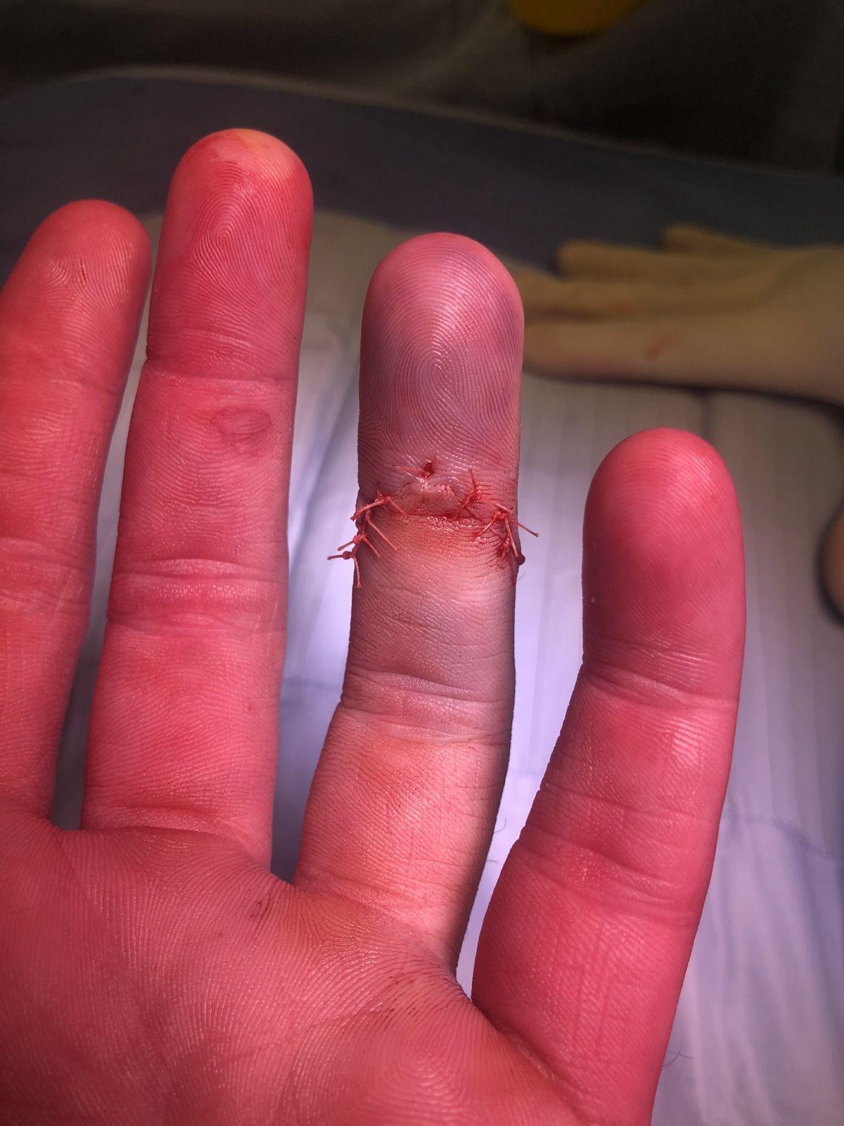 Jimmy Neesham tweeted a photo of his finger in stiches after the surgery