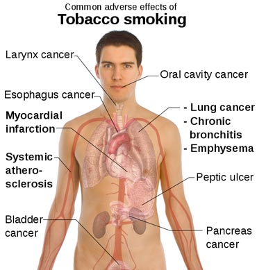 A representation of adverse effects of smoking