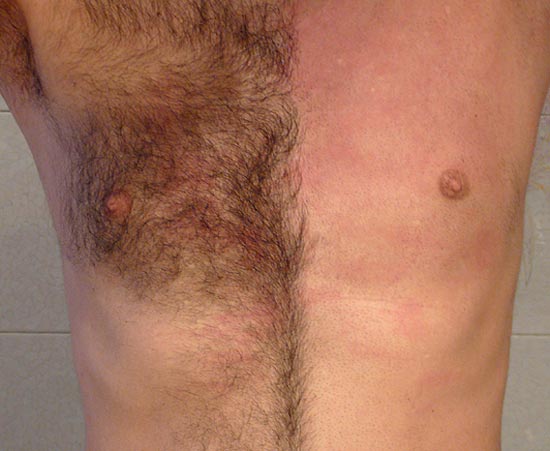 Mens Before  After Photos of Laser Hair Removal  Milan Laser in Elkhart  IN
