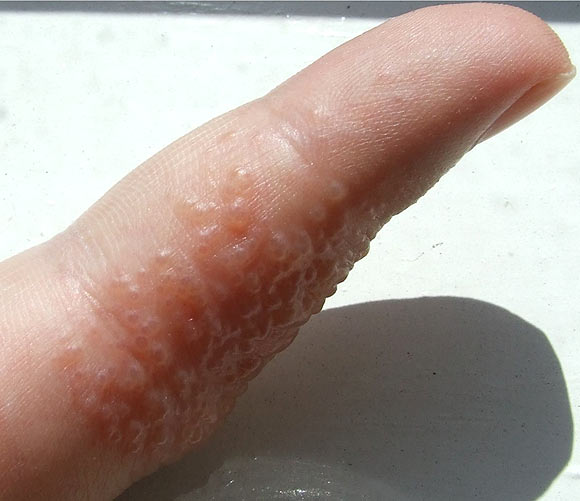 Eczema is an itchy skin rash