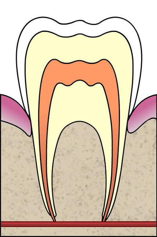 Intrinsic causes of tooth discolouration