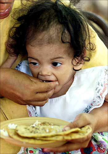 18-month-old Honduran Yamileth Funez suffers from malnutrition.