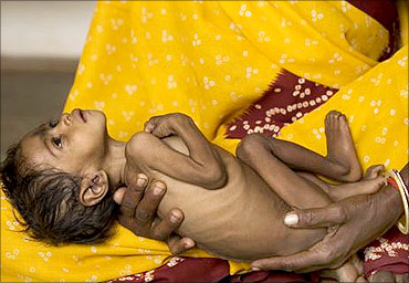 A malnourished baby in India.