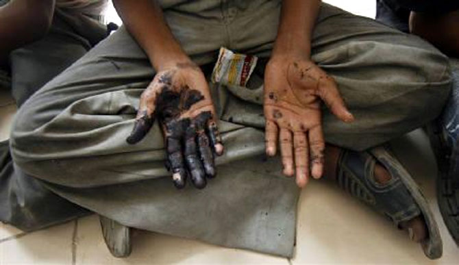 A child labourer shows his hands smeared with what he says are chemicals.