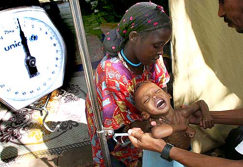 A malnourished child is being weighed at a UNICEF-supported therapeutic feeding centre in Somalia