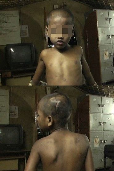 Injury marks on the body of a 7-year-old rescued from Kalimullah's factory