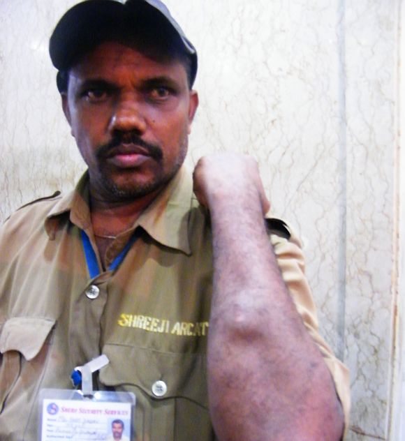 Security guard Hari Yadav suffered injuries on his hand, legs, eyes and back.