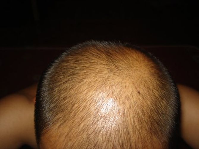 The 'pull' behind male hair loss