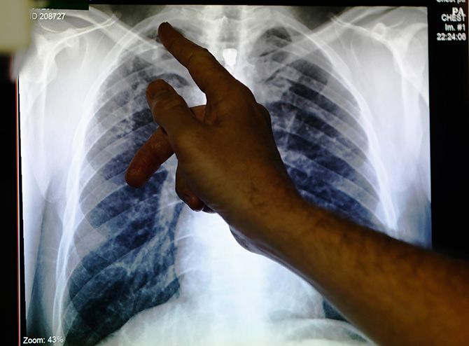 An x-ray showing a pair of lungs infected with TB. Photograph: Luke MacGregor/Reuters