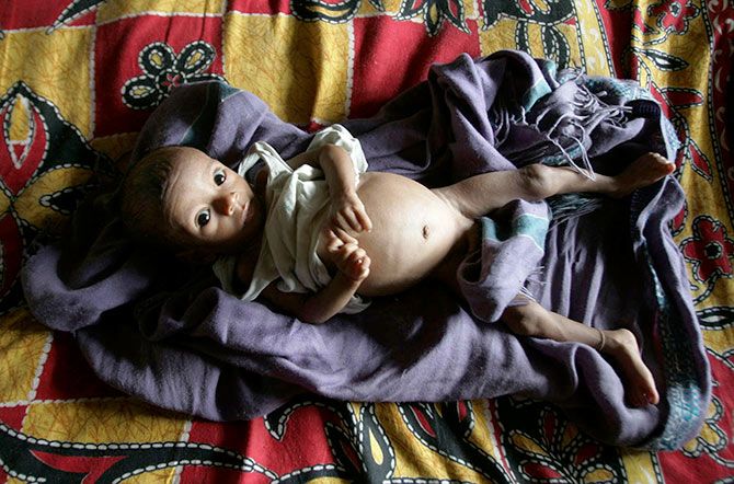 Five-month-old Rotiya Ashur, who suffers from tuberculosis, rests inside the tuberculosis ward of a hospital on the outskirts of Siliguri, West Bengal. Photograph: Rupak De Chowdhuri/Reuters