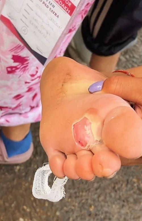 Sonam Wangchuk shared this image of a Ladakhi fellow protester's blistered feet