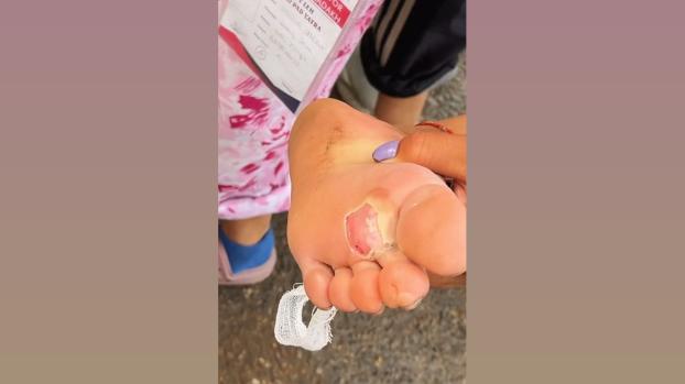 Sonam Wangchuk shared this image of a Ladakhi fellow protester's blistered feet