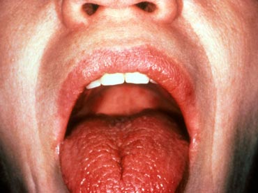Dry mouth is one of the symptoms of Sjogren's Syndrome