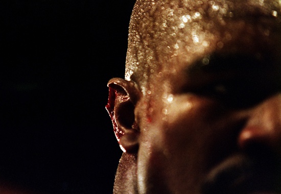 A close-up of the injury to the right ear of Evander Holyfield