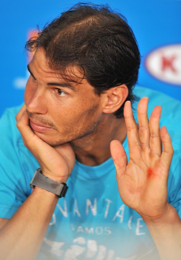 Rafael Nadal of Spain shows his blistered hand