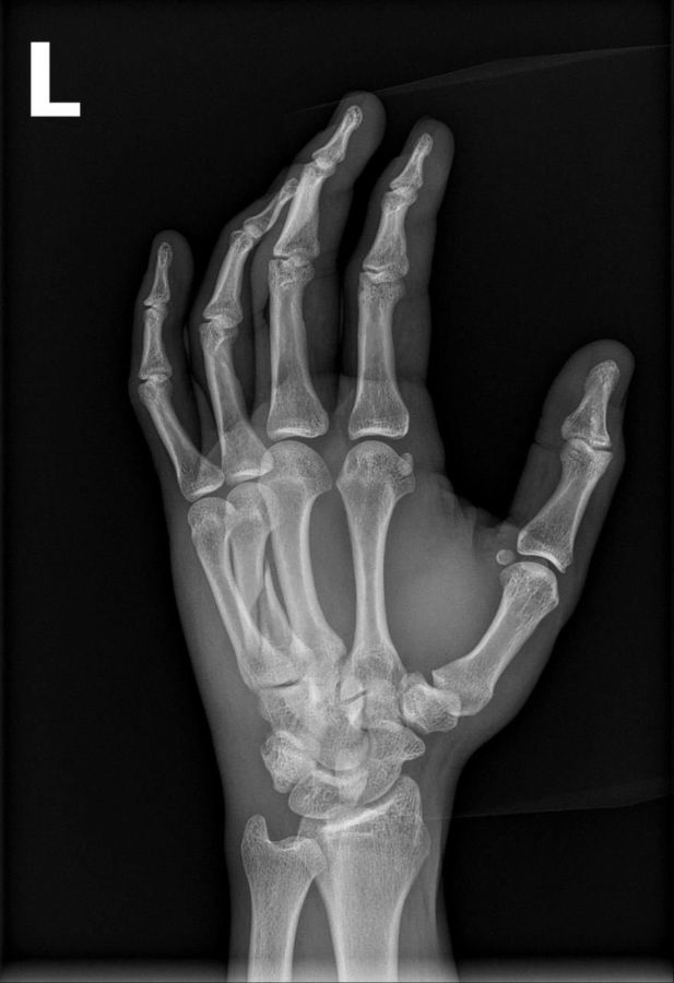 An x-ray of Neeraj Chopra's hand injury